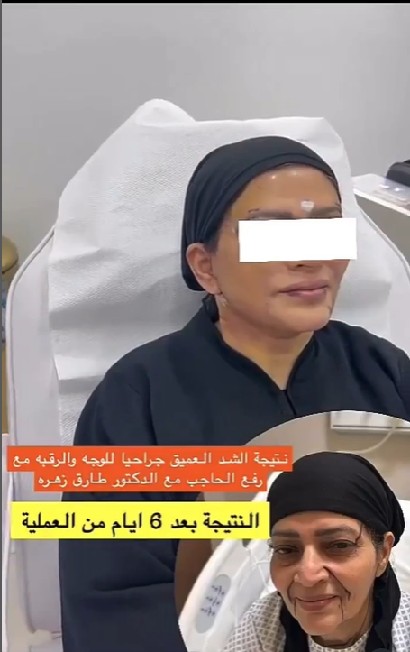 رفع-الحواجب