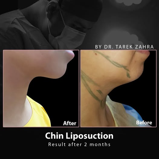 شفط-اللغلوغ