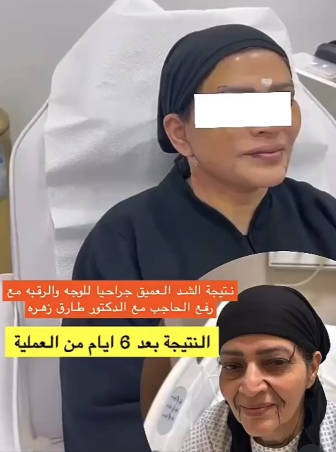 تصغير-الثدي