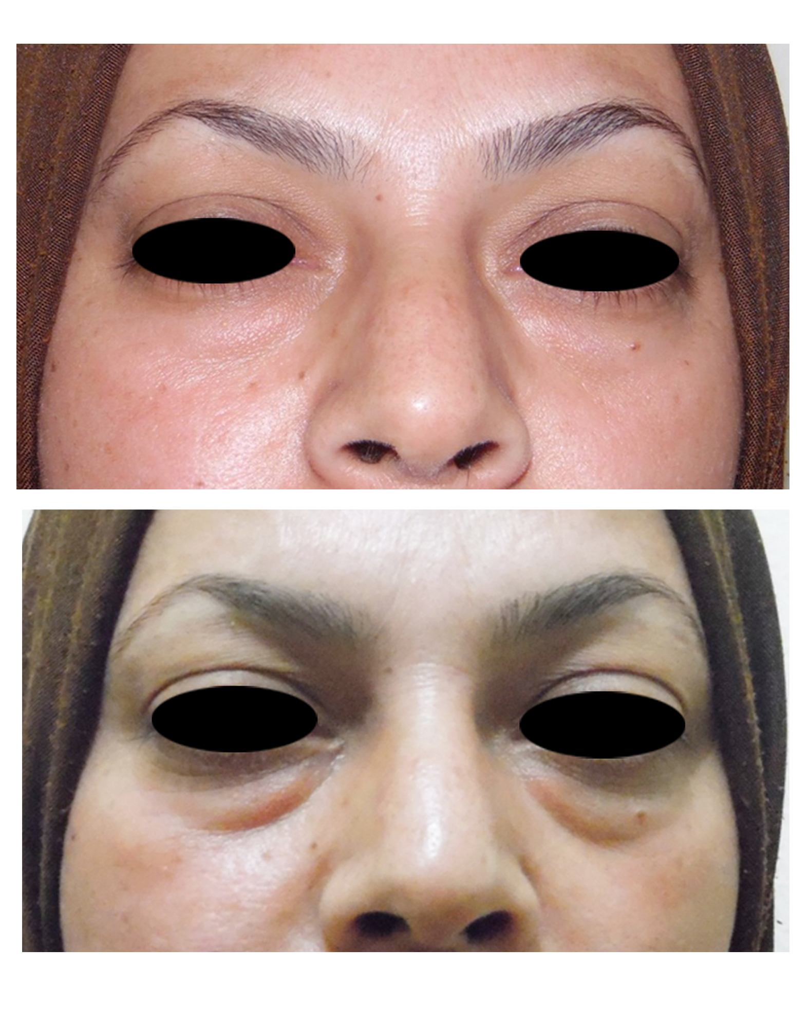 استعادة-جمال-العينين-والوجه-بعملية-تجميل-الجفون-السفلية